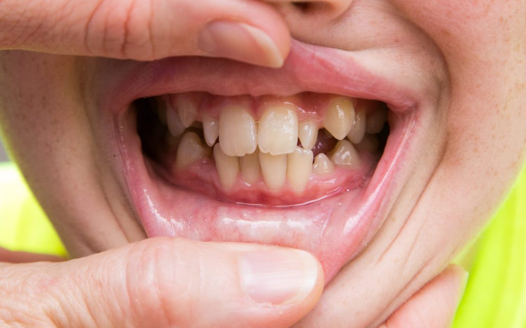 Braces: How To Tell When Your Kid Needs Them