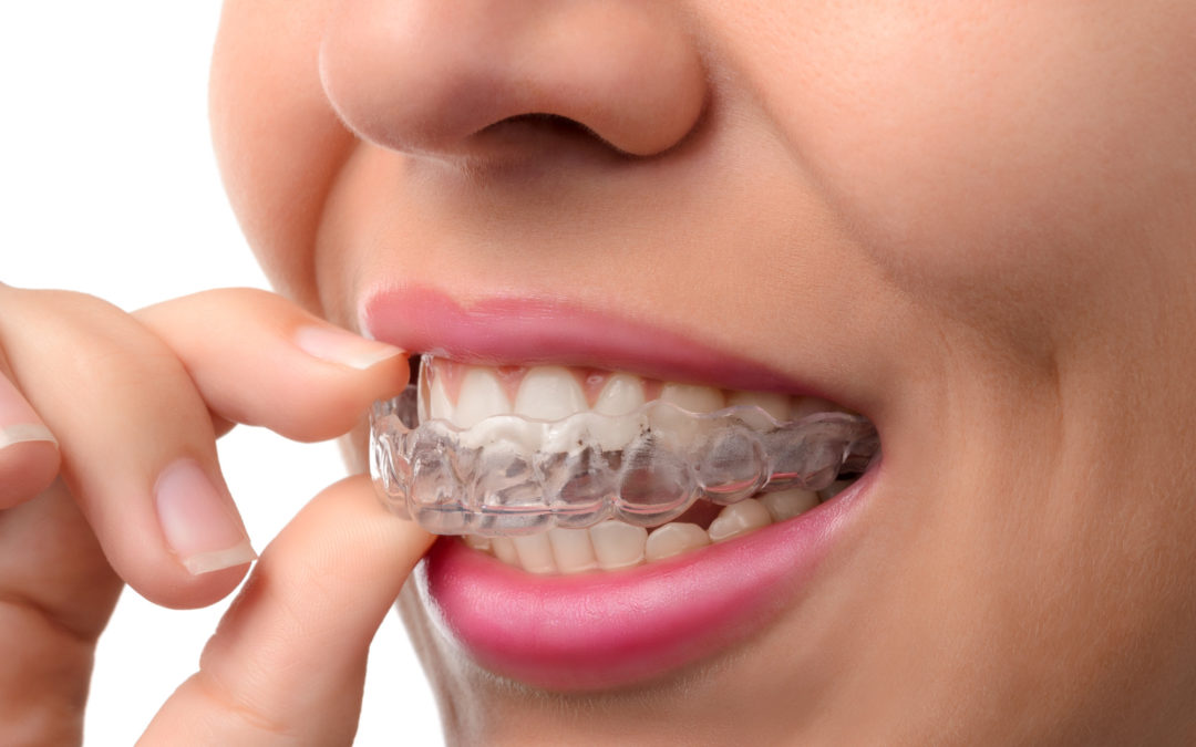 7 Helpful Invisalign Tips to Get The Most Out of Your Treatment