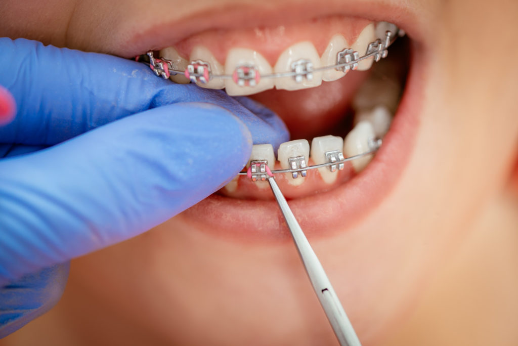 difference between Invisalign and braces
