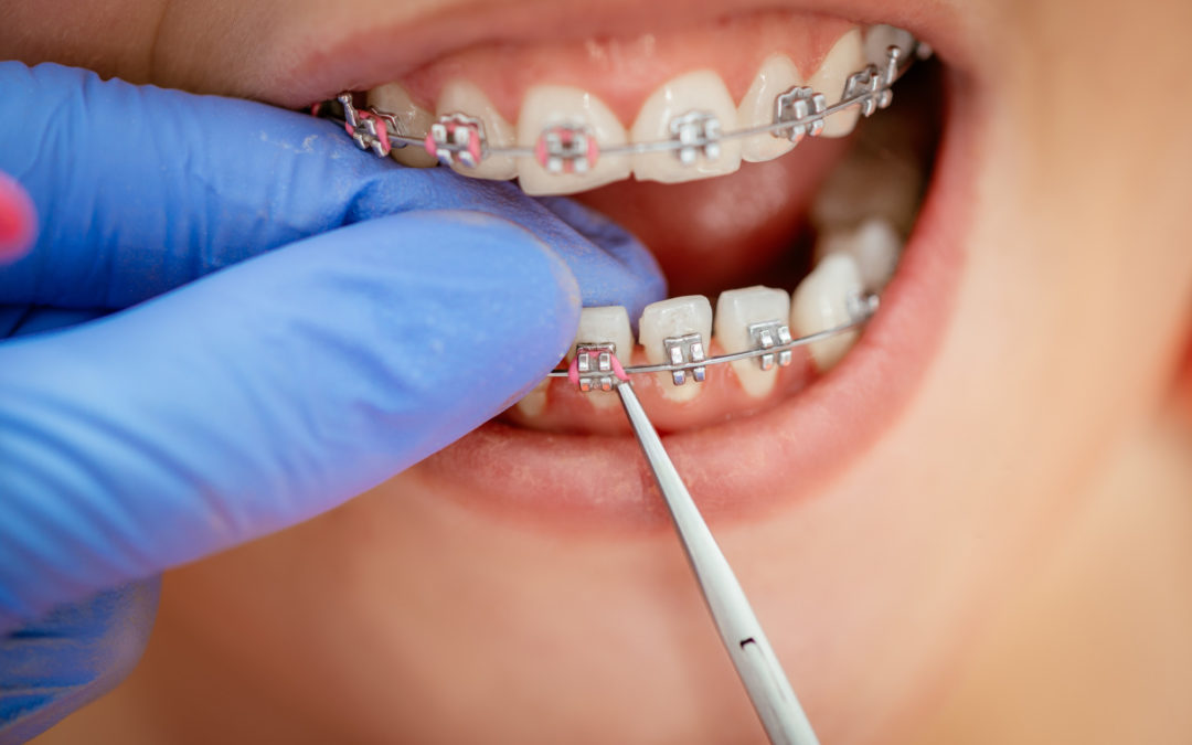 5 Steps to Take If You Have a Broken Bracket on Your Braces