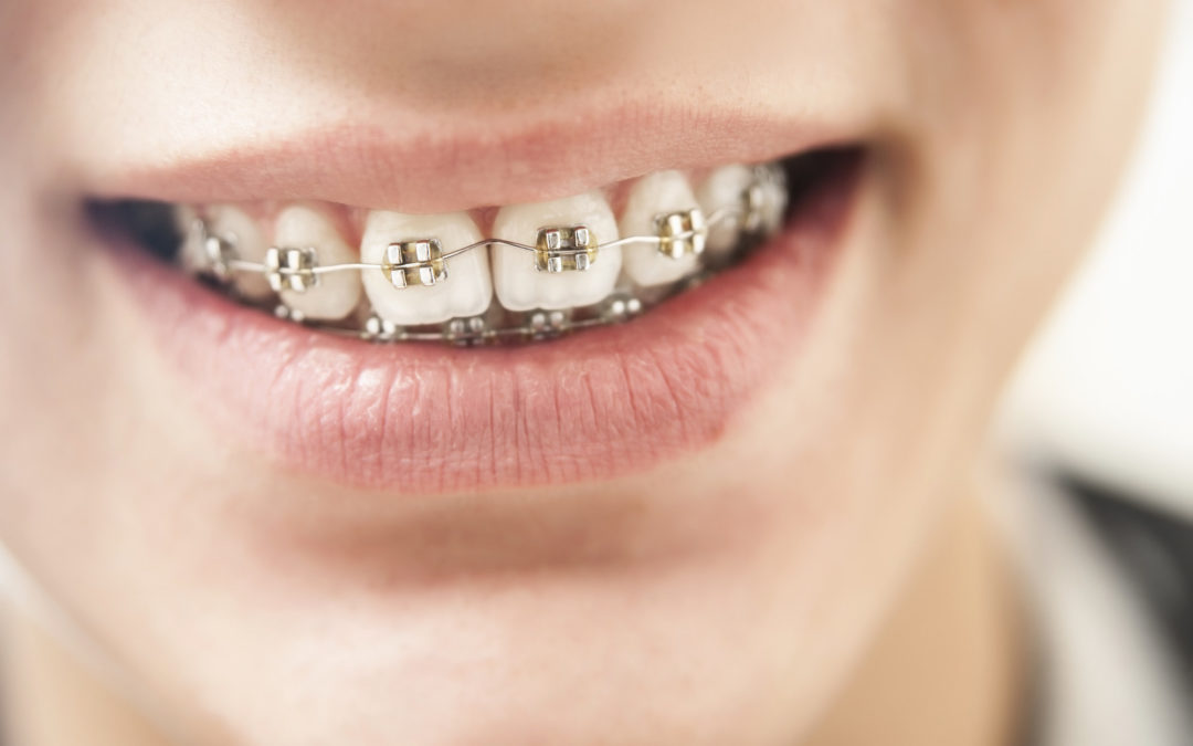 Braces for Children: How to Talk to Your Kids About Getting Braces