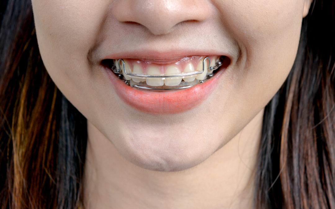 Here Is Why the Cleveland Orthodontics Team Will Bring Back Your Smile